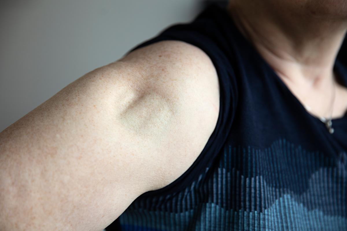 Lipoatrofi viser sig som fordybninger i huden på injektionssteder.